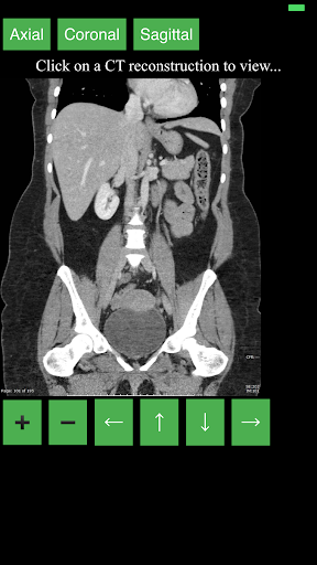 اسکرین شات 2 برنامه CT Abdomen Pelvis