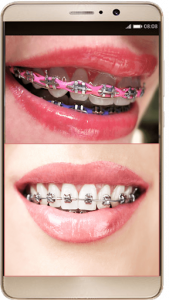 اسکرین شات برنامه Braces Photo Editor - Braces For Your Teeth 3