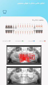 اسکرین شات برنامه تشخیص پوسیدگی دندان از روی عکس OPG 3